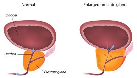 Transurethral Resection Of The Prostate - TURP Procedure - Healthgrades.com